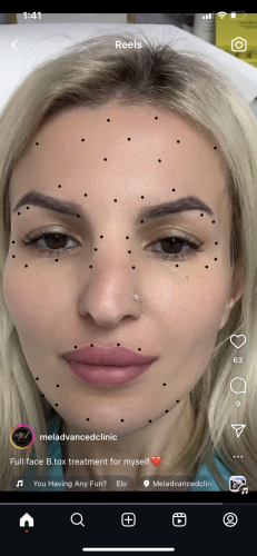 ReNTox 200 Units photo review