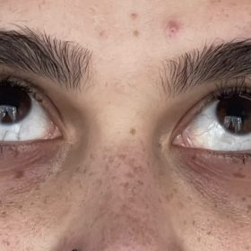 Rejuran HB photo review