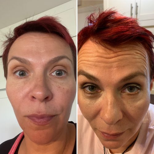 Innotox 50 Units (Exp: Dec 18, 2026) photo review