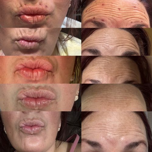 Innotox 50 Units (Exp: Dec 18, 2026) photo review