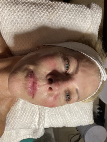 Innotox 50 Units (Exp: Dec 18, 2026) photo review