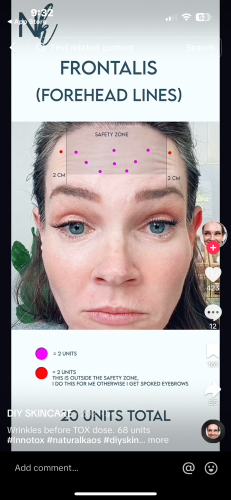 Innotox 50 Units (Exp: Dec 18, 2026) photo review