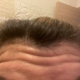 Innotox 50 Units (Exp: Dec 18, 2026) photo review