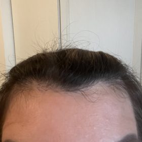 Innotox 50 Units (Exp: Dec 18, 2026) photo review