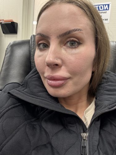 Innotox 50 Units (Exp: Dec 18, 2026) photo review