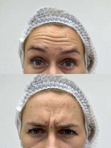 Innotox 50 Units (Exp: Dec 18, 2026) photo review