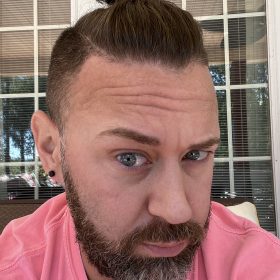 Botulax 200 Units photo review