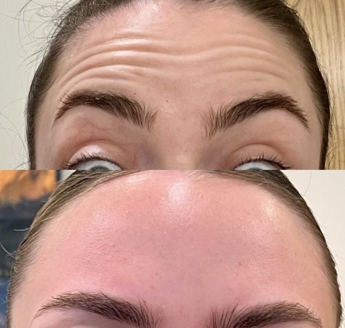 Botulax 200 Units photo review