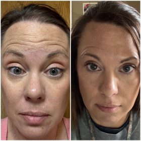 Botulax 200 Units photo review