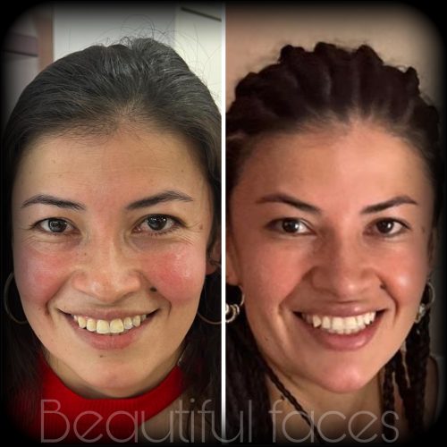 Botulax 200 Units photo review