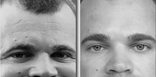 Click to view full screen Innotox 100 Units photo review