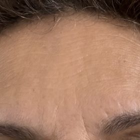 Innotox 100 Units photo review