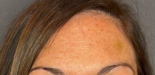 Botulax 200 Units photo review