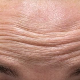 Innotox 100 Units photo review