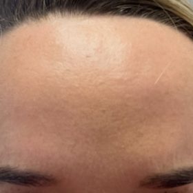 Innotox 100 Units photo review