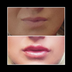 Botulax 200 Units photo review