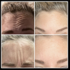 Botulax 200 Units photo review