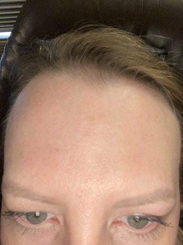 Innotox 100 Units photo review