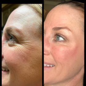 Botulax 200 Units photo review