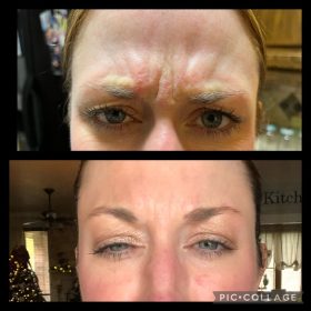 Botulax 200 Units photo review