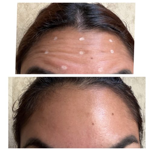 Botulax 200 Units photo review