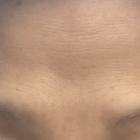 Botulax 200 Units photo review