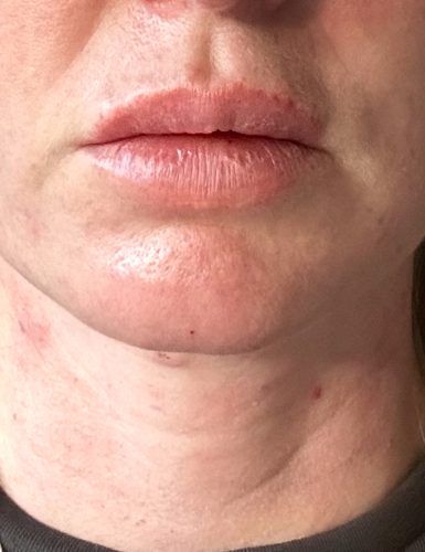 Innotox 100 Units photo review