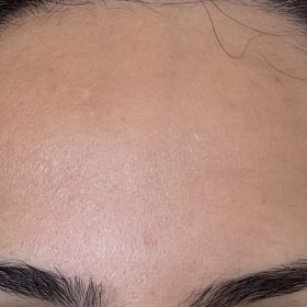 Botulax 200 Units photo review