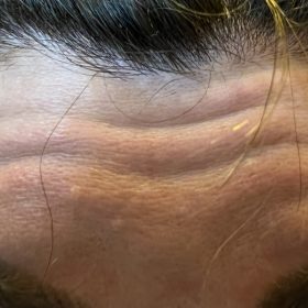 Innotox 100 Units photo review