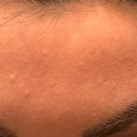 Innotox 100 Units photo review