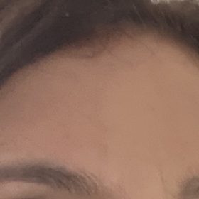 Innotox 100 Units photo review