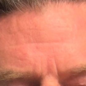 Botulax 200 Units photo review