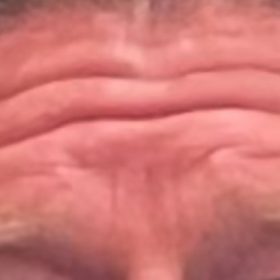 Botulax 200 Units photo review