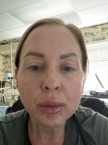 Botulax 200 Units photo review