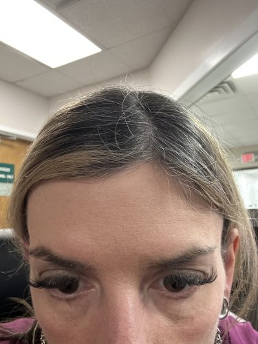 Innotox 100 Units photo review