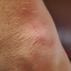 Laennec 10 ampules photo review