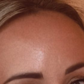 Coretox 100 Units photo review