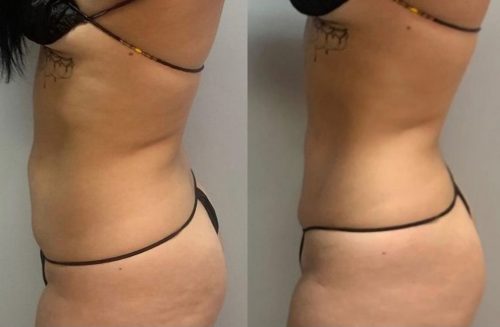 Dr. Lipo+ (Body) photo review