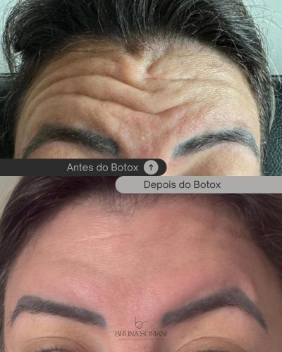 Metox 100 Units photo review