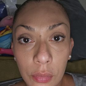 Metox 100 Units photo review