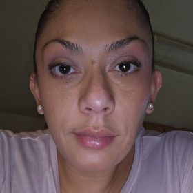 Metox 100 Units photo review