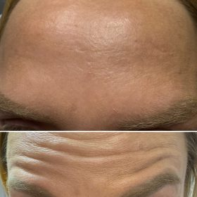 Metox 100 Units photo review