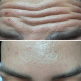 Metox 100 Units photo review