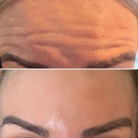 Metox 100 Units photo review