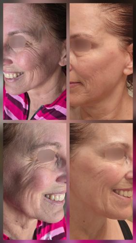 Metox 100 Units photo review