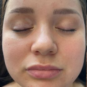 Metox 100 Units photo review