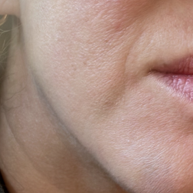 Metox 100 Units photo review