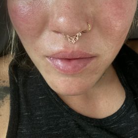 Metox 100 Units photo review