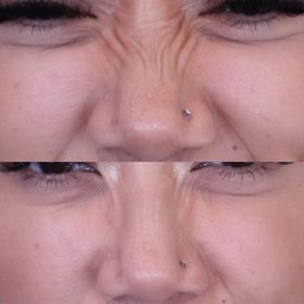 Metox 100 Units photo review