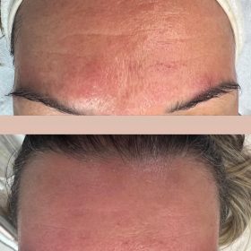 Metox 100 Units photo review